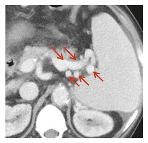 Splenorenal shunt. In a 62-year-old female with liver cirrhosis, the ...