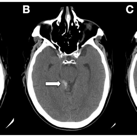 Ct Ac Demonstrating Sah In The Quadrigeminal And Supracerebellar