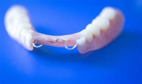 Tips On How To Maintain Removable Partial Dentures