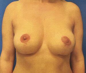 Breast Reconstruction Austin Tx Dr Weinfeld