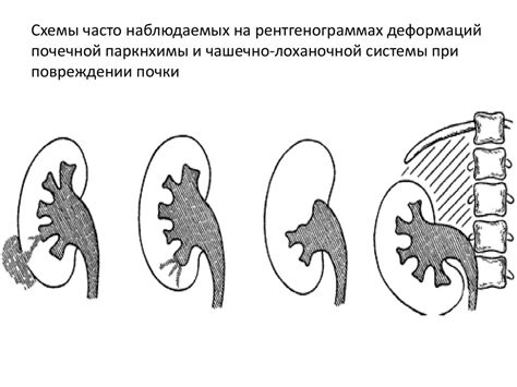 Почечная колика - презентация онлайн