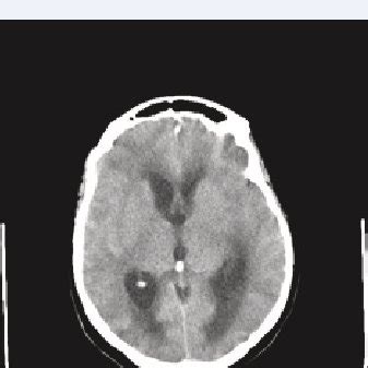 Axial Non Contrasted CT Scan Demonstrating Acute Hydrocephalus With