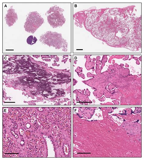 Placental Histological Pathologies A A Slide With The Four Villous