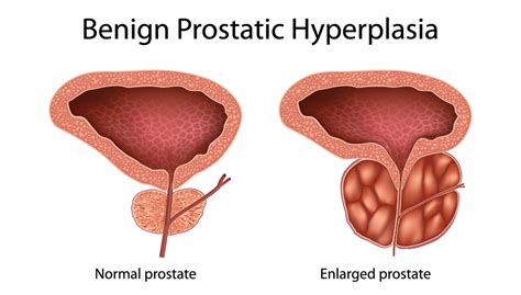 What Is Prostate Enlargement And Treatment