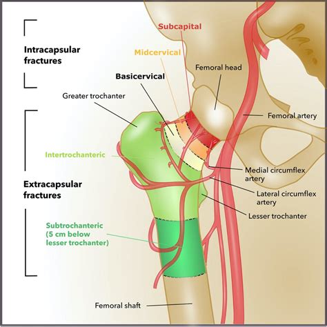 Bony and vascular anatomy of the proximal femur (adapted from [8 ...