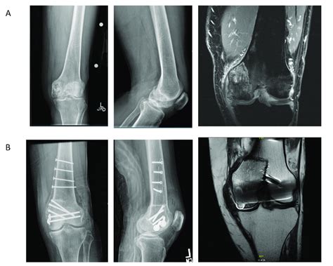 A Pre Operative Anteroposterior AP And Lateral Radiographs Of The