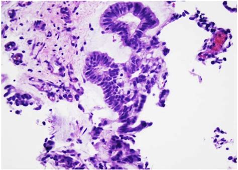 Photomicrograph Of Orbital Medulloepithelioma In A 9 Year Old Girl