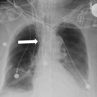 Portable Chest Radiography Limited By The Patient S Body Habitus