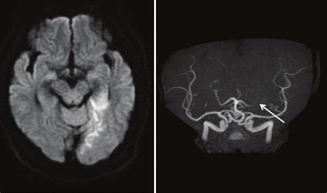 Diffusion Weighted Magnetic Resonance Images A On Admission