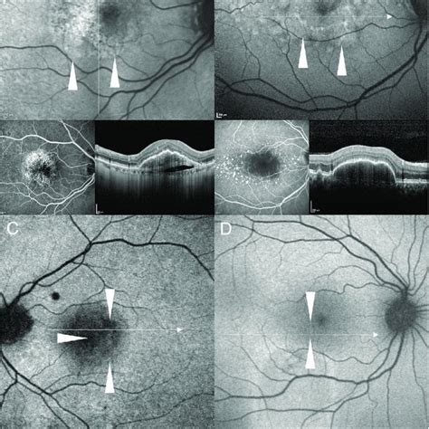 Fundus Autofluorescence Faf Images Showing The Four Main Types Of Faf