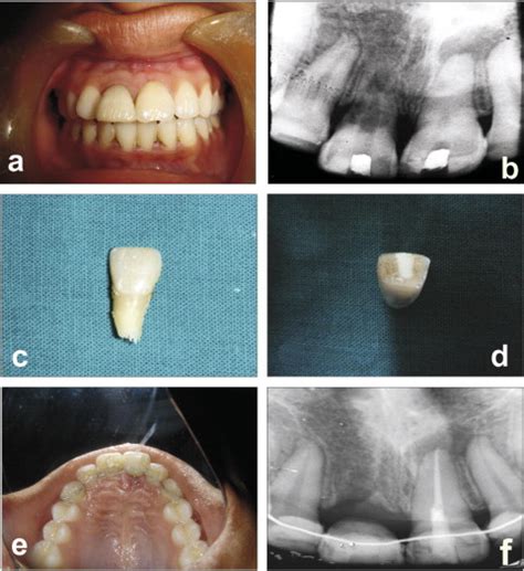 A Preoperative Clinical View B Preoperative Radiograph C Download Scientific Diagram