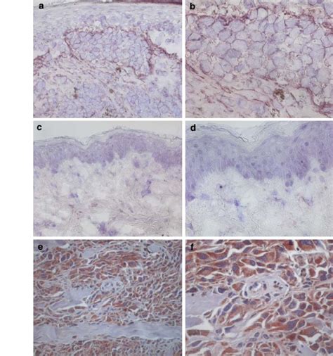 Expression Of Fapa And Survivin In Tumors Fapa Is Expressed By