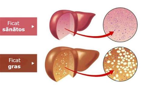 Steatoza hepatică: remedii naturiste şi regim alimentar - Doftoria.ro