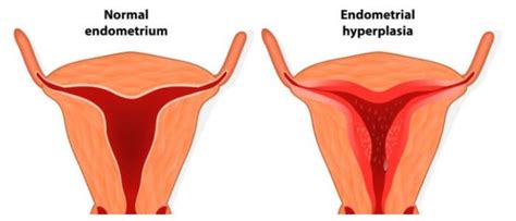 Endometrial Hyperplasia Symptoms And Treatment Hoool Health Wellness