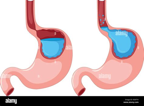 Diagram Of Gastroesophageal Reflux Disease Illustration Stock Vector