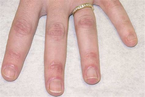 Dermatomyositis Hands