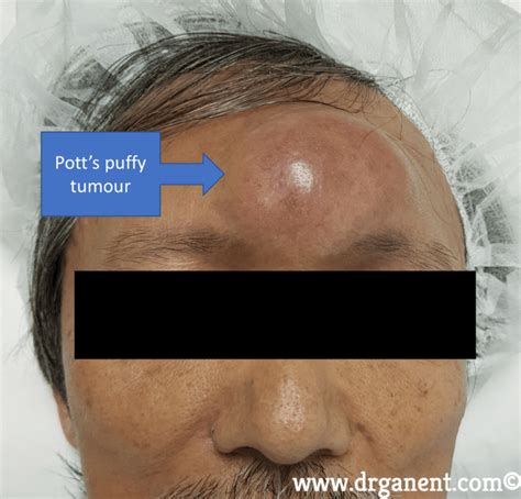 Potts Puffy Tumour A Rare But Serious Complication Of Sinusitis