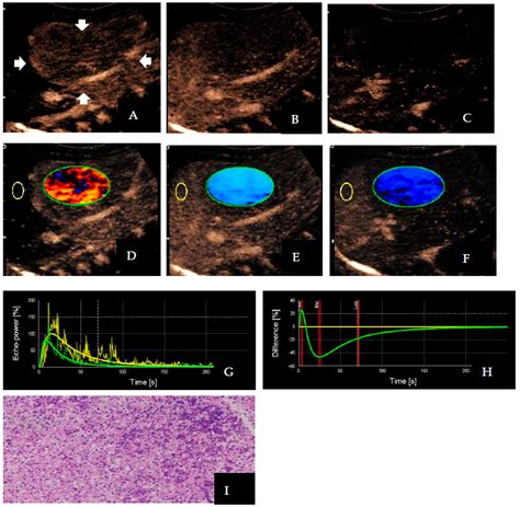 Application Of Quantitative Parameters Of Contrast Enhanced Ultrasound