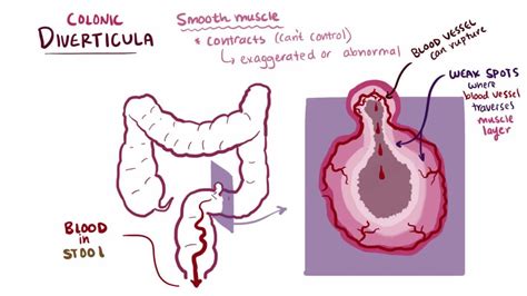 Diverticulosis Sigmoid Colon