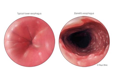 Optimizing Surveillance In Patients With Dysplastic Barrett Esophagus