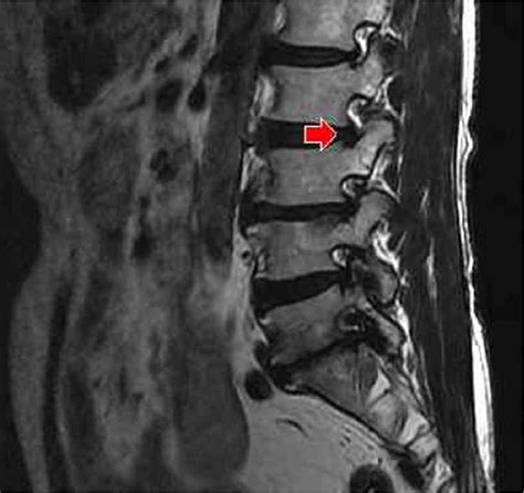 Figure 1 From Added Value Of MR Myelography Using 3D COSMIC Sequence In