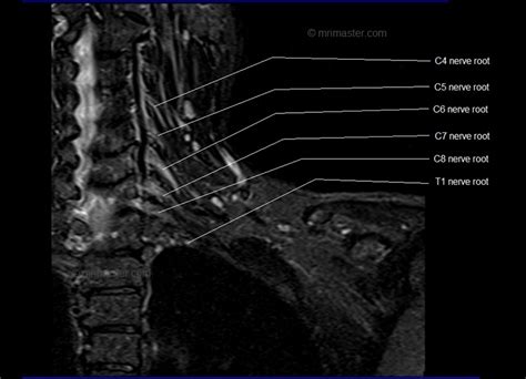 Mri Brachial Plexus Anatomy Free Mri Coronal Cross Sectional Anatomy