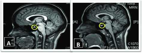 Posterior Pituitary Bright Spot Ppbs A Presence Of Ppbs And B