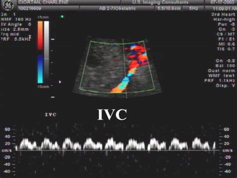 Inferior Vena Cava Ultrasound