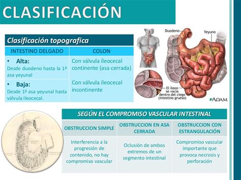 Obstruccion intestinal Cirugía