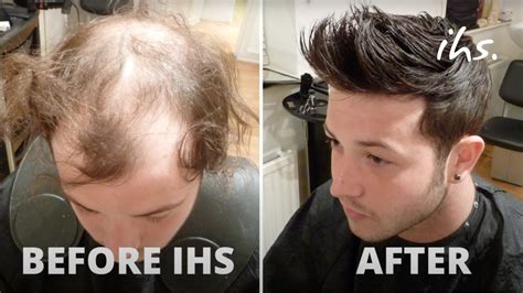 Hair Loss Success Story Youtube