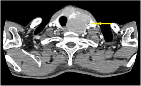 Ct Scan Showed Large Masses In The Isthmus And Left Lobes Of The Thyroid Download Scientific