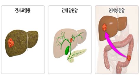 서울대학교암병원