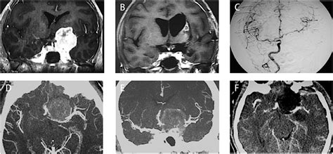 Frontiers Anterior Clinoidal Meningiomas Meningeal Anatomical Considerations And Surgical