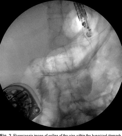 Figure 1 From Endoscopic Ultrasound Eus Directed Transgastric