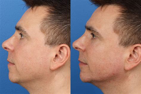 Jaw Contouring New York City Gotham Plastic Surgery