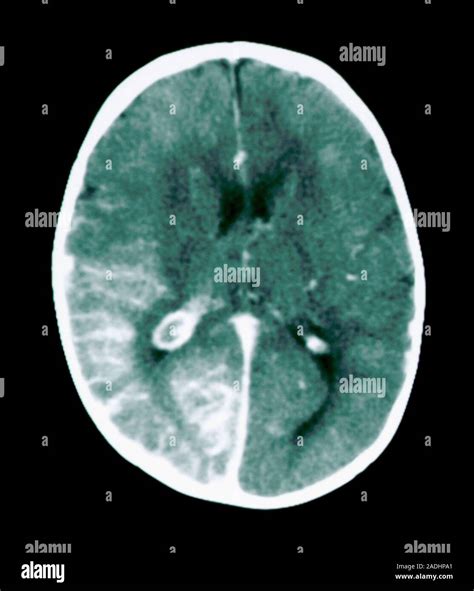 Sturge-Weber syndrome. Magnetic resonance imaging (MRI) scan of a brain (grey) with Sturge-Weber ...