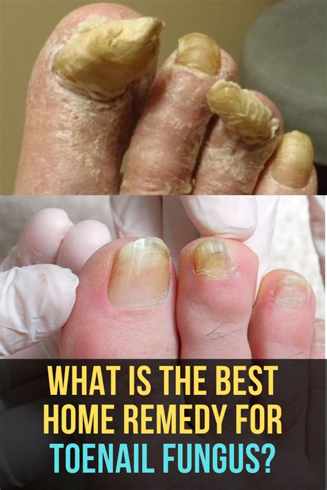 Toenail Fungus Treatment What S The Best Way To Get Rid Of Toenail Fungus And Yellow Toenails