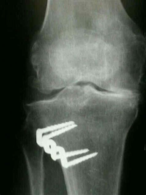 Understanding High Tibial Osteotomy Hto Surgery 52 Off