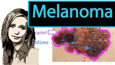 Melanoma Abcde Rule