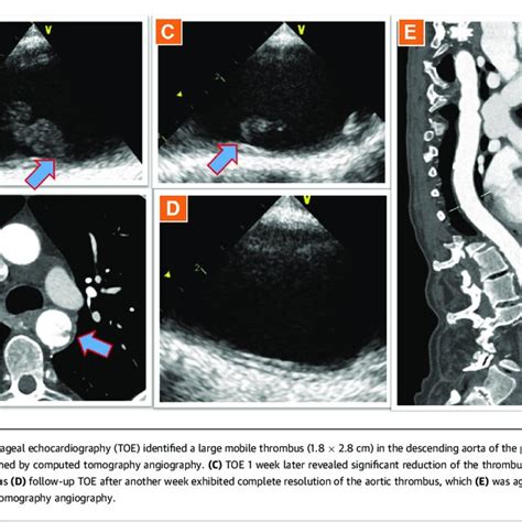 Transesophageal Echocardiography And Computed Tomography Angiography