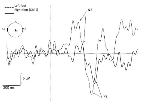 Grand Average Of A∂ Fiber Related Laser Evoked Potentials Lep Download Scientific Diagram