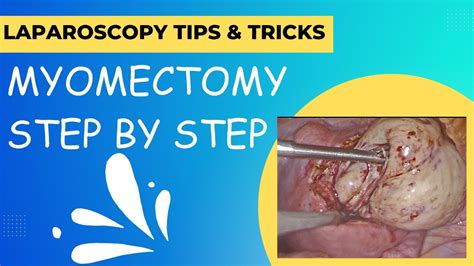 Myomectomy Step By Step YouTube