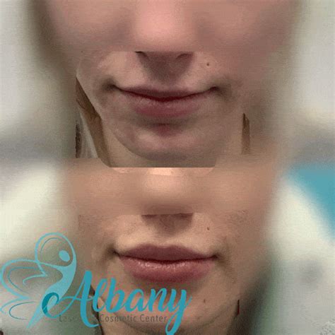 Enhancing Lips Shape With Filler Injections Case Albany Cosmetic