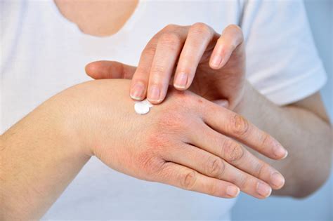 Mild Eczema Knuckles