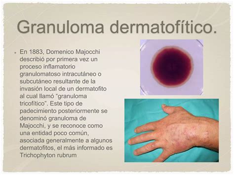 Micosis Superficiales Y Candidiasis Ppt