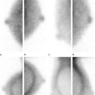 High Resolution Breast Specific Scintimammogram In A Patient With