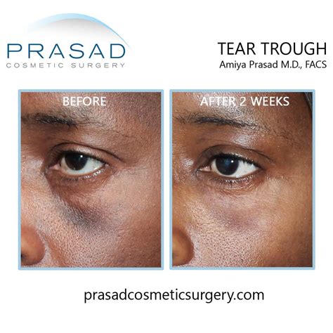 What is the Best Treatment for Under Eye Hollows? | Dr. Prasad Blog
