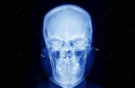 Xray Tengkorak Dan Tulang Belakang Leher Dengan Tulang Dari Hidung Ke