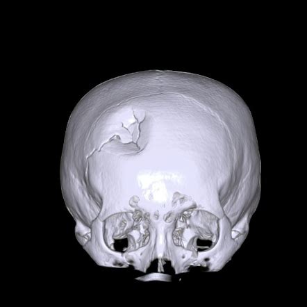 Depressed Skull Fracture Radiology Reference Article Radiopaedia Org