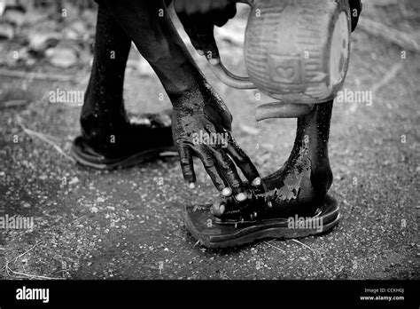 Crippled Feet Hi Res Stock Photography And Images Alamy